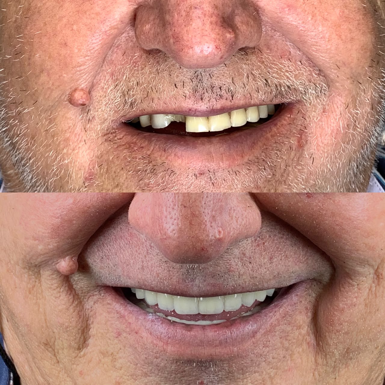 Caso antes e depois 4